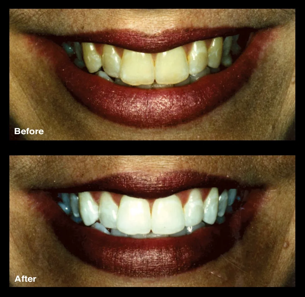 25299 whitening toothpastes