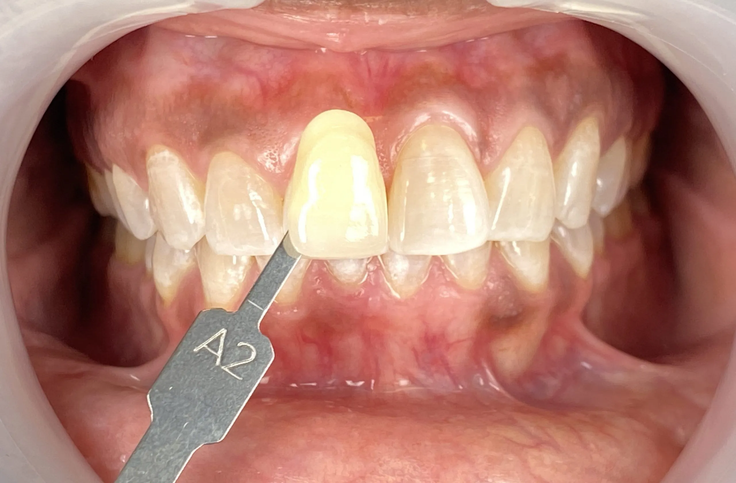 25310 avoid staining foods