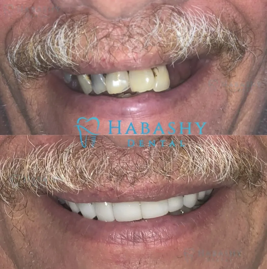 25317 teeth whitening palm beach gardens at home kit