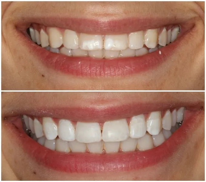 25319 teeth whitening morrisville procedure