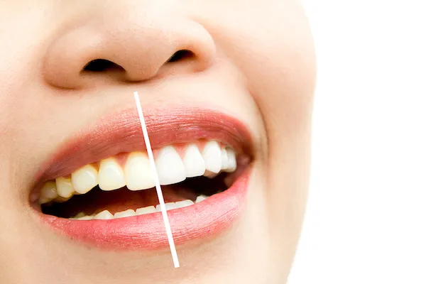 25319 teeth whitening types morrisville