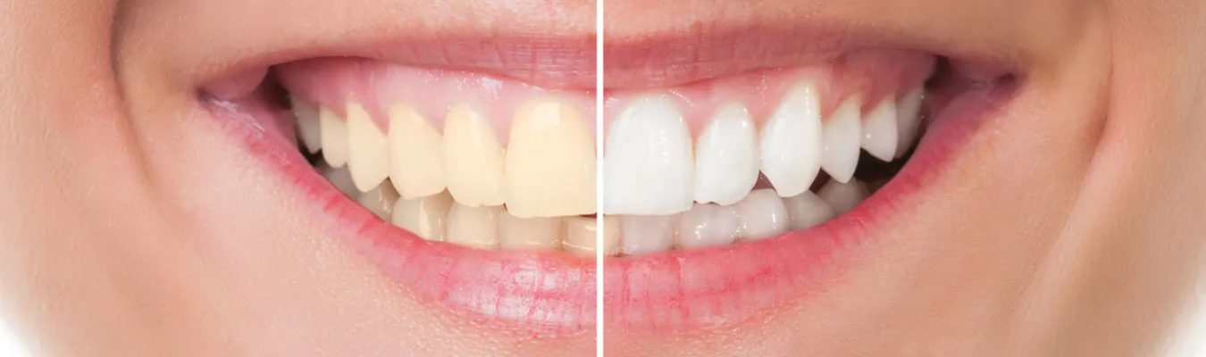 25320 at home teeth whitening