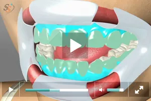 25320 professional teeth whitening