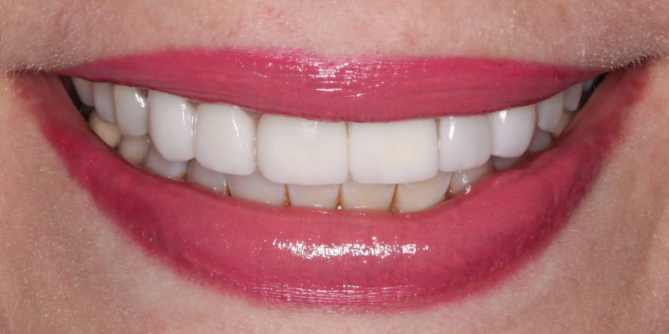 25320 teeth whitening options