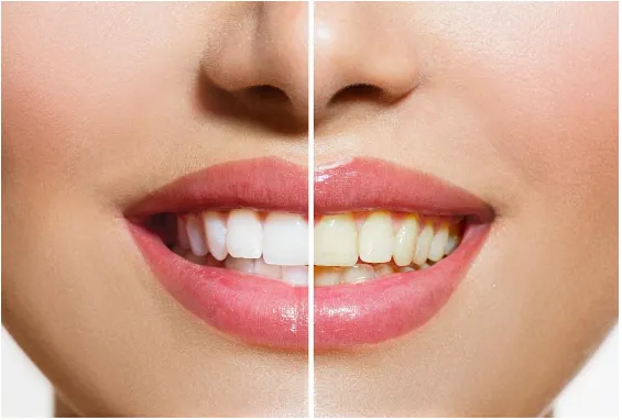 25321 tooth discomfort after whitening