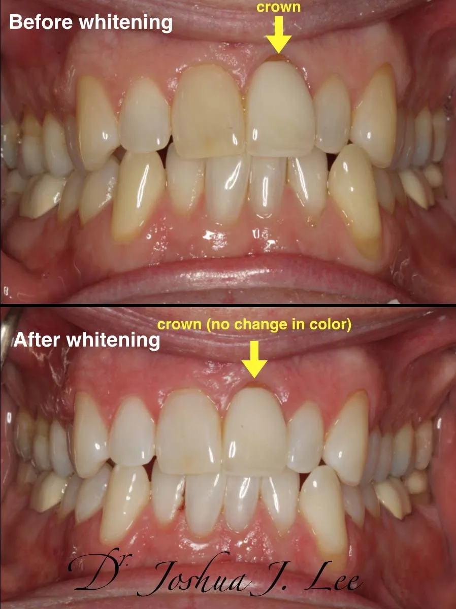 25328 zoom whitening before after