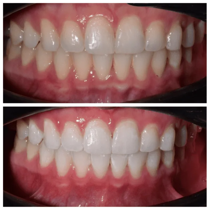 25328 zoom whitening light application