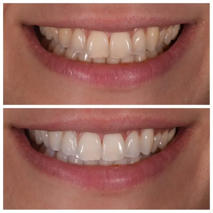 25328 zoom whitening patient with mouth guard