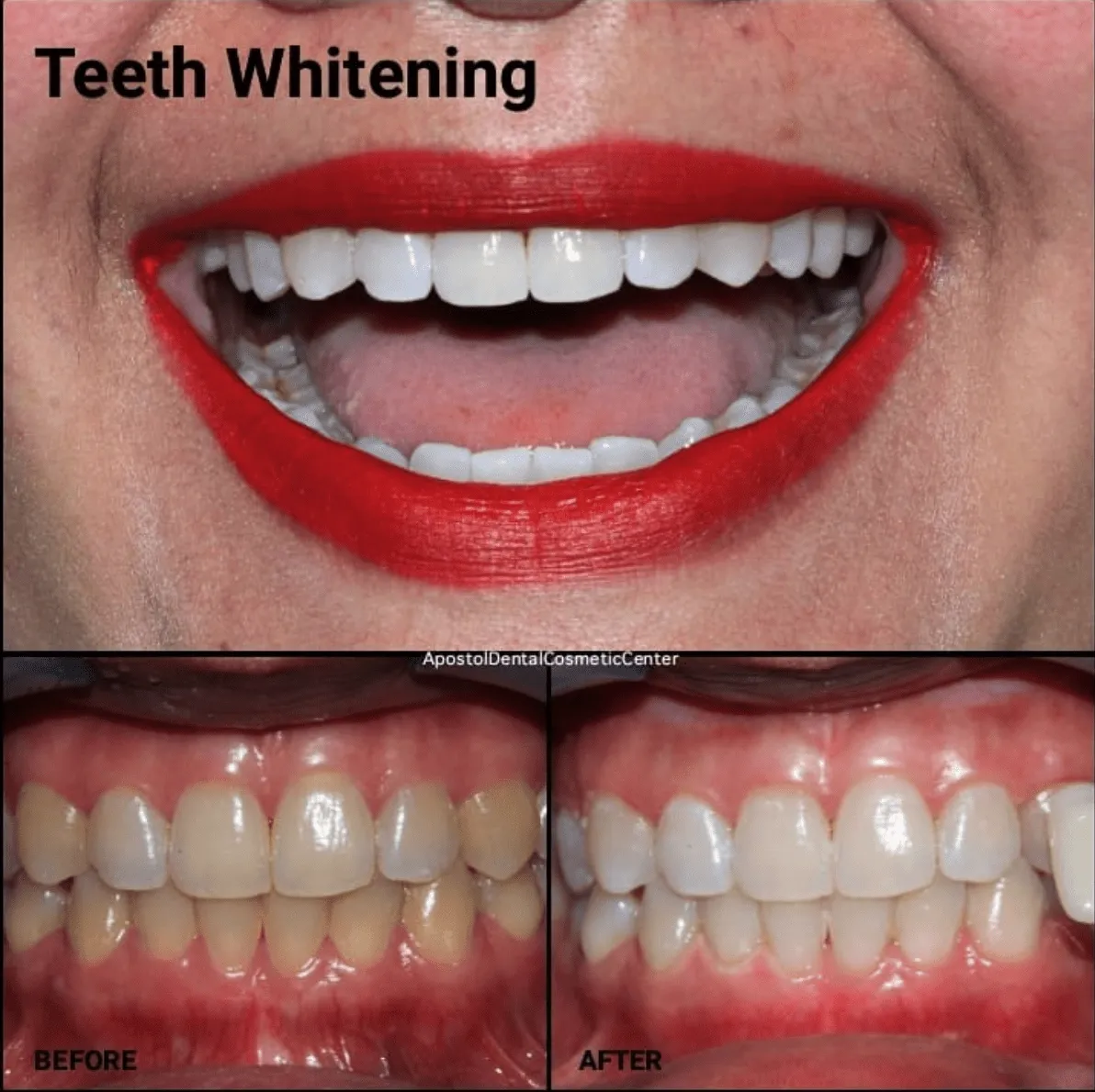 /img/25329-acv-teeth-whitening-alternatives.webp