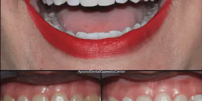 /img/25329-acv-teeth-whitening-alternatives.webp