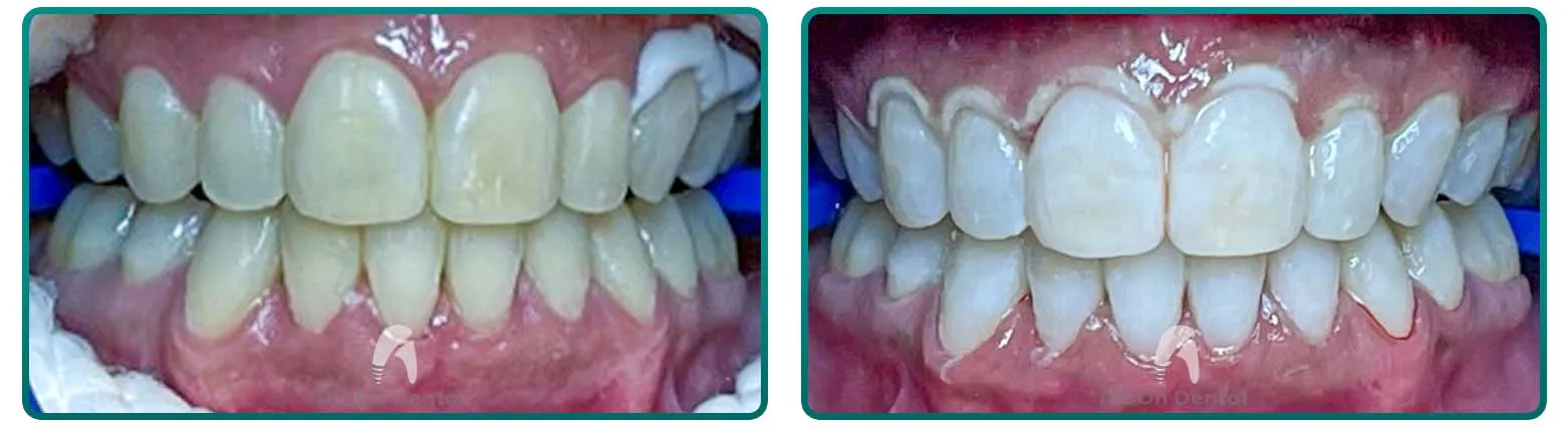 25329 acv teeth whitening before after