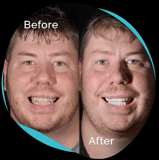 25332 cancun teeth whitening staining foods