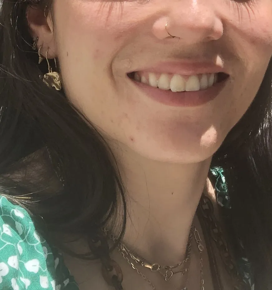 25336 pearl whitening spot removal