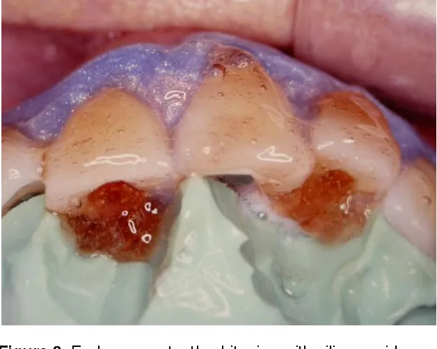 25337 teeth whitening comparison