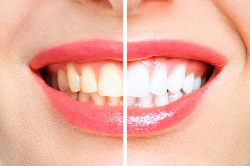 /img/25368-teeth-whitening-eugene-oregon-happy-patient.webp