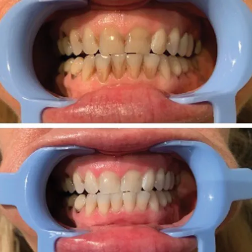 25368 teeth whitening eugene oregon provider search