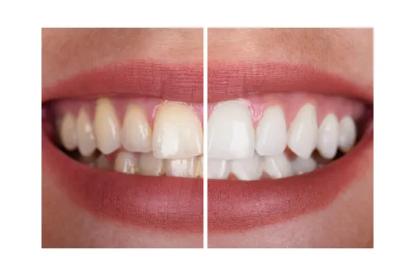 25369 laser teeth whitening