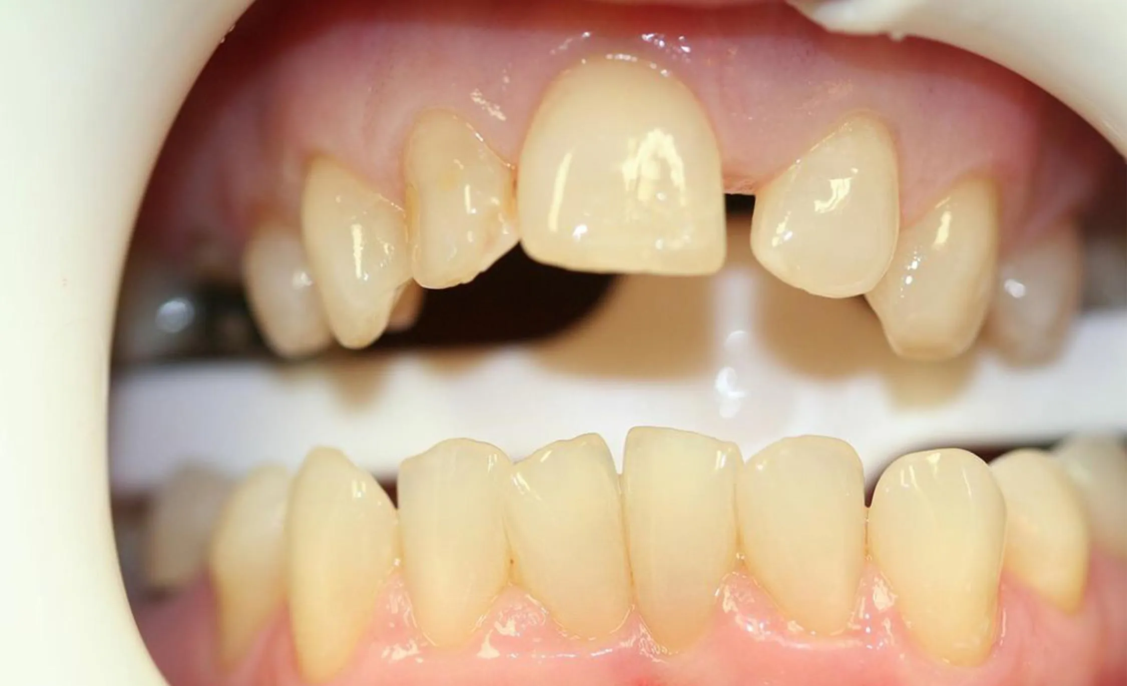 25370 teeth whitening strips