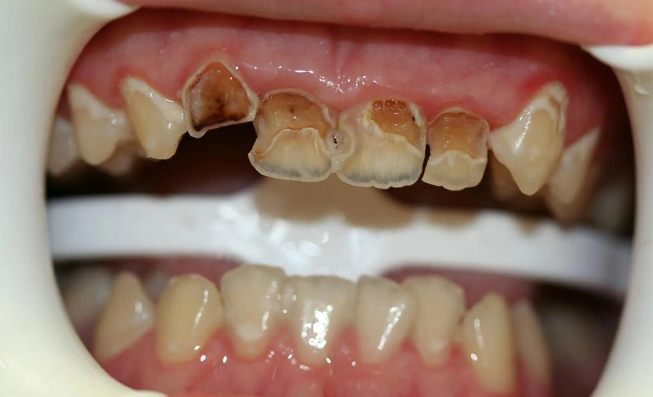 25370 whitening toothpaste