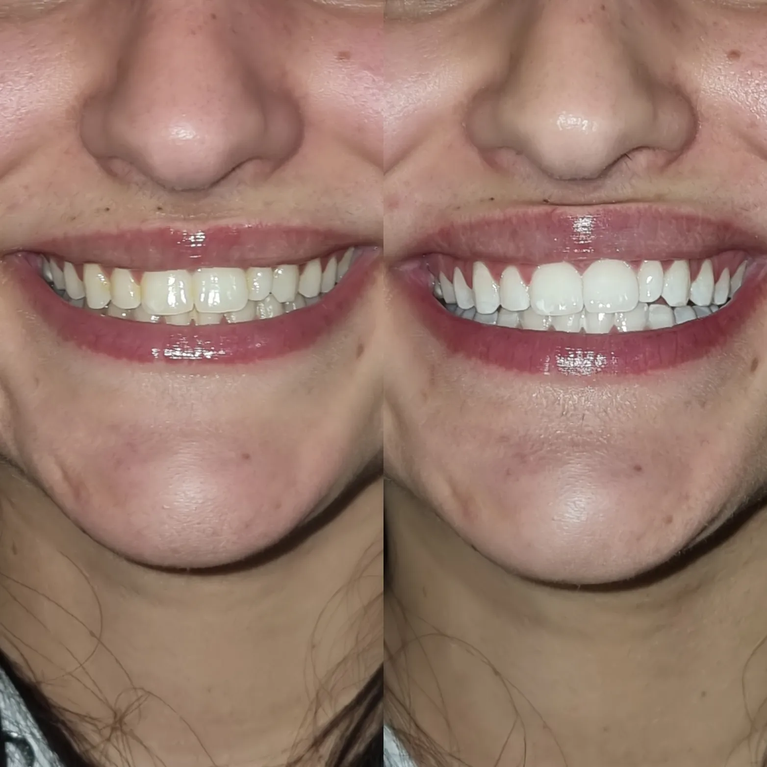 25376 at home teeth whitening