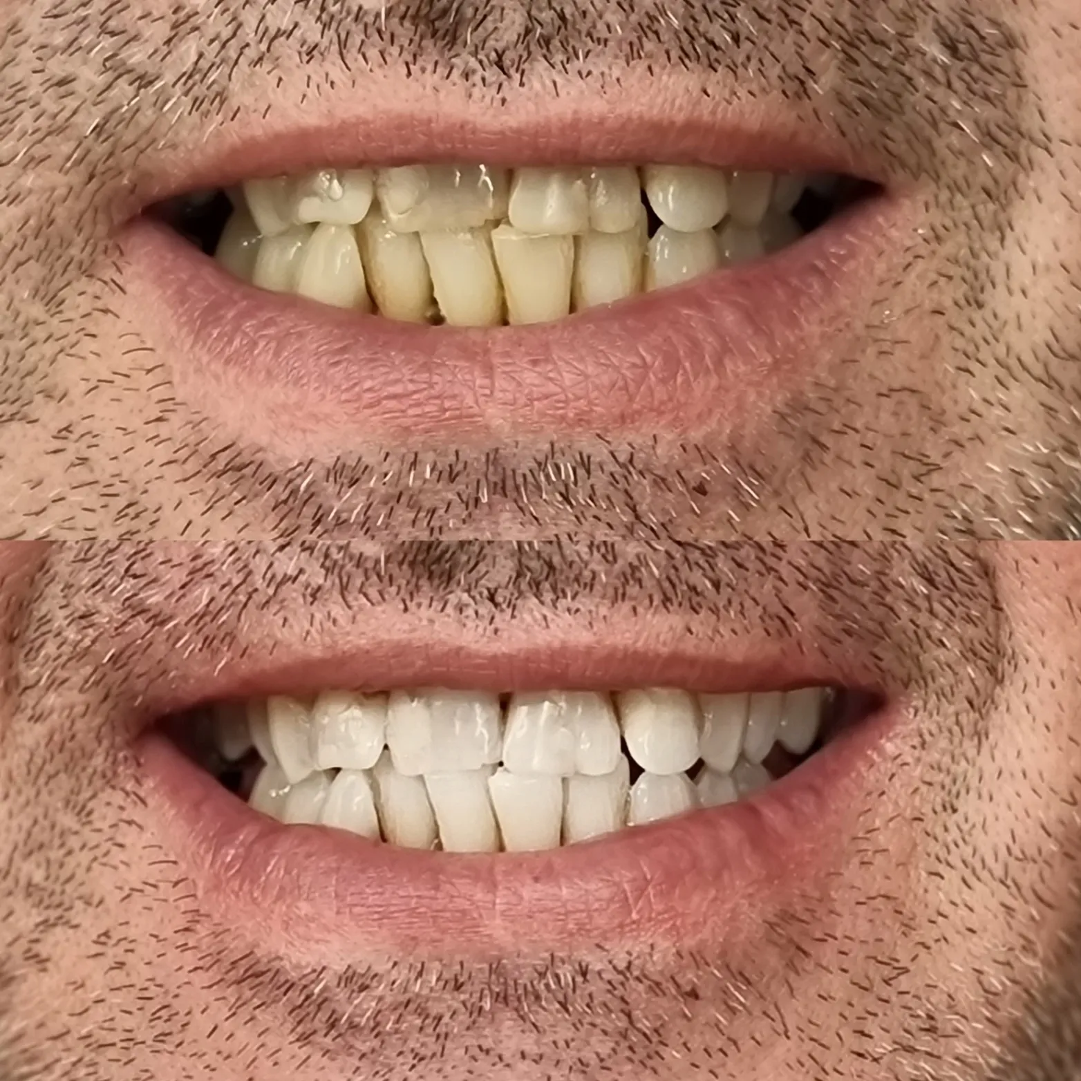 25376 teeth whitening comparison