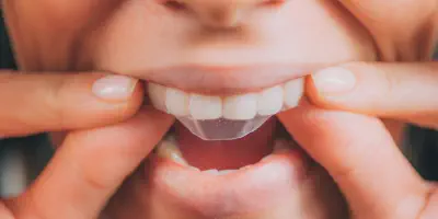 /img/25377-teeth-whitening-timeline.webp