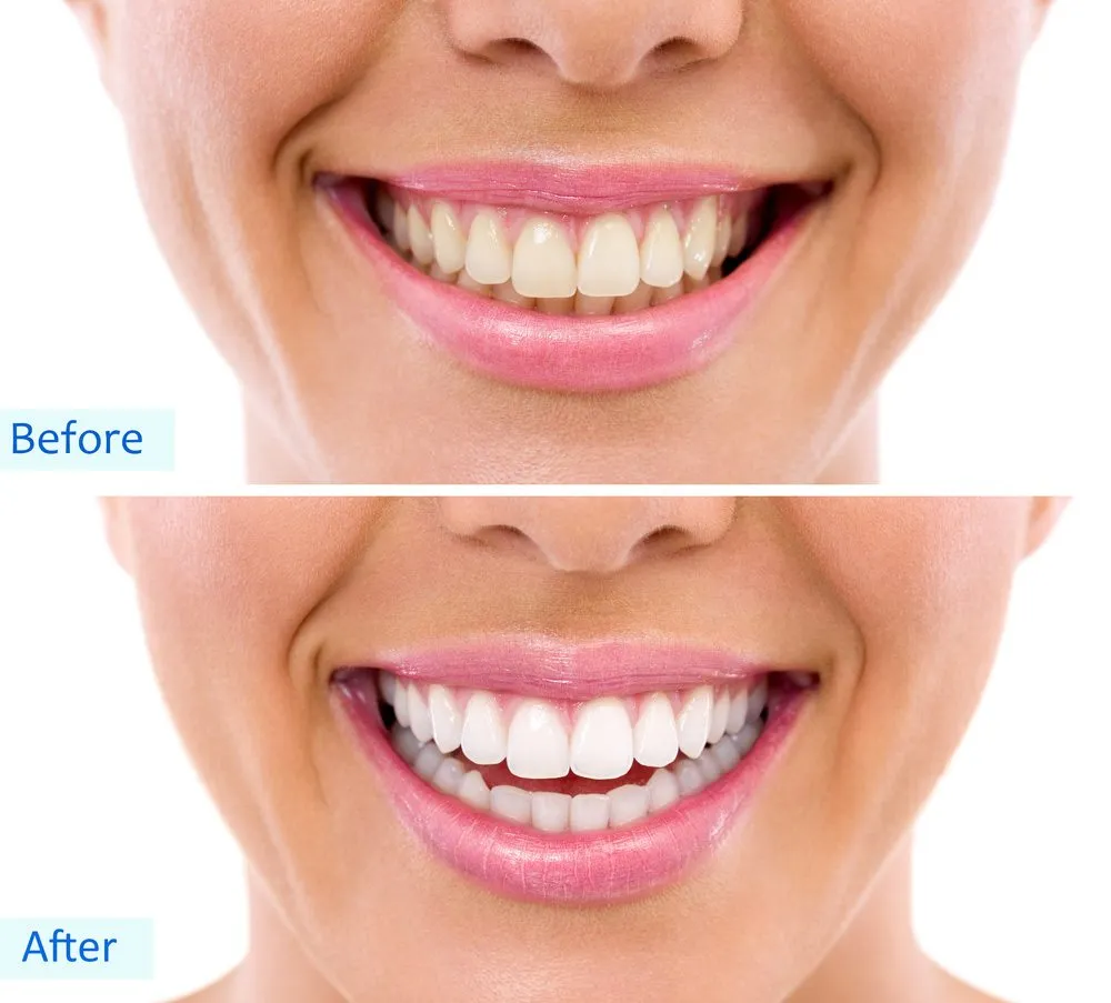 25378 teeth whitening comparison