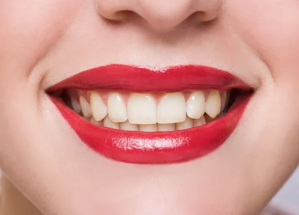 25380 teeth whitening burlington home kit