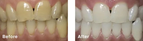 25380 teeth whitening burlington in office