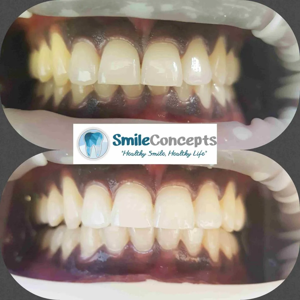 25386 at home teeth whitening