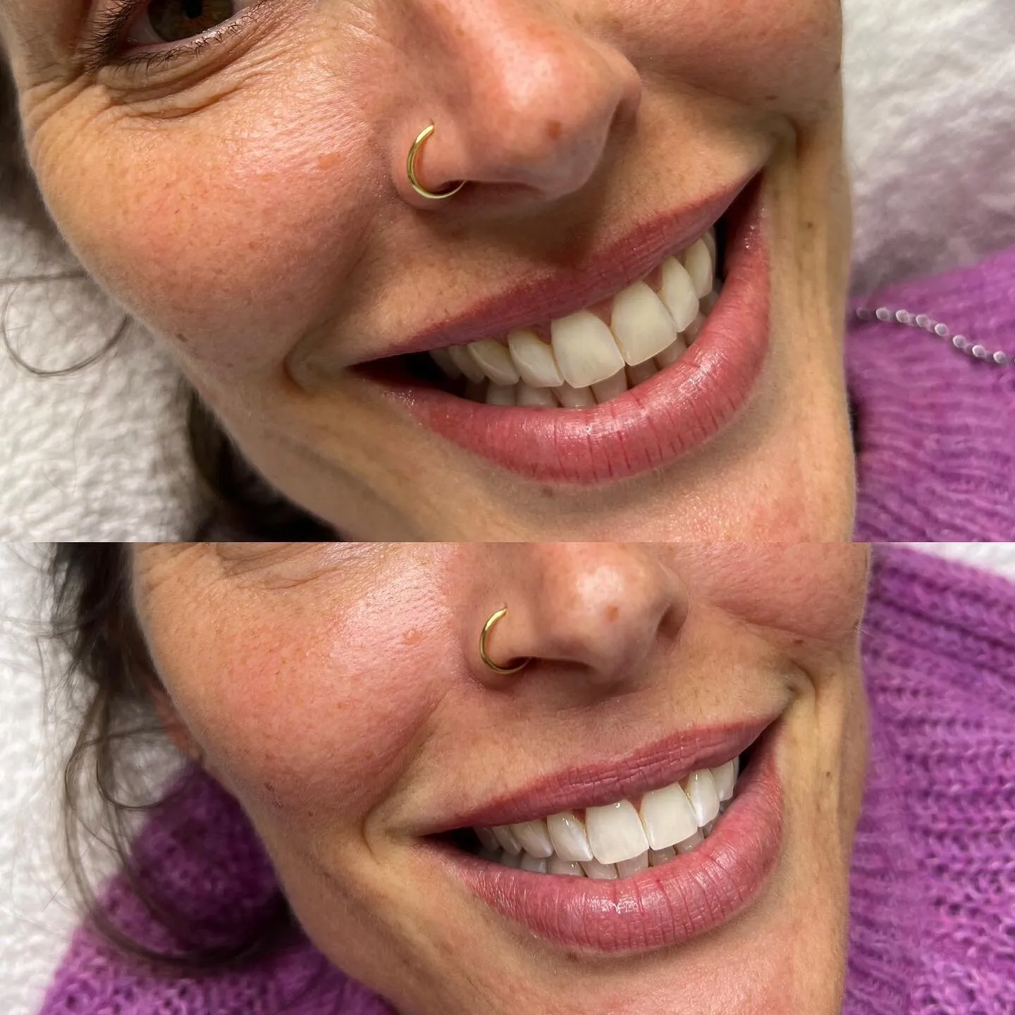 25386 professional teeth whitening