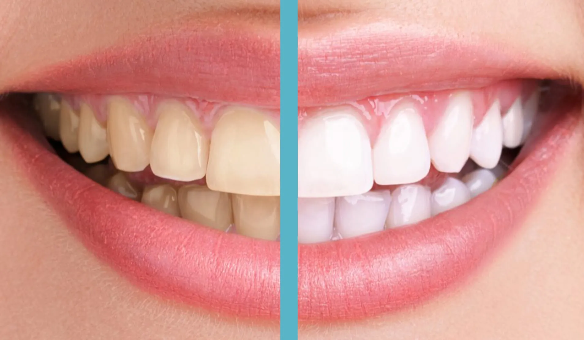 25386 teeth whitening benefits