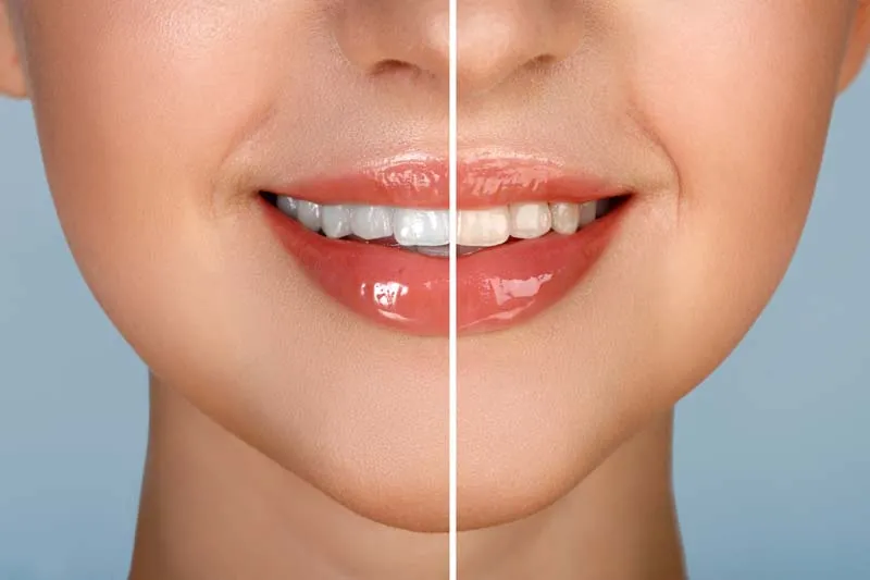 25386 teeth whitening cost