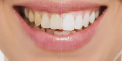 /img/25387-teeth-whitening-results.webp