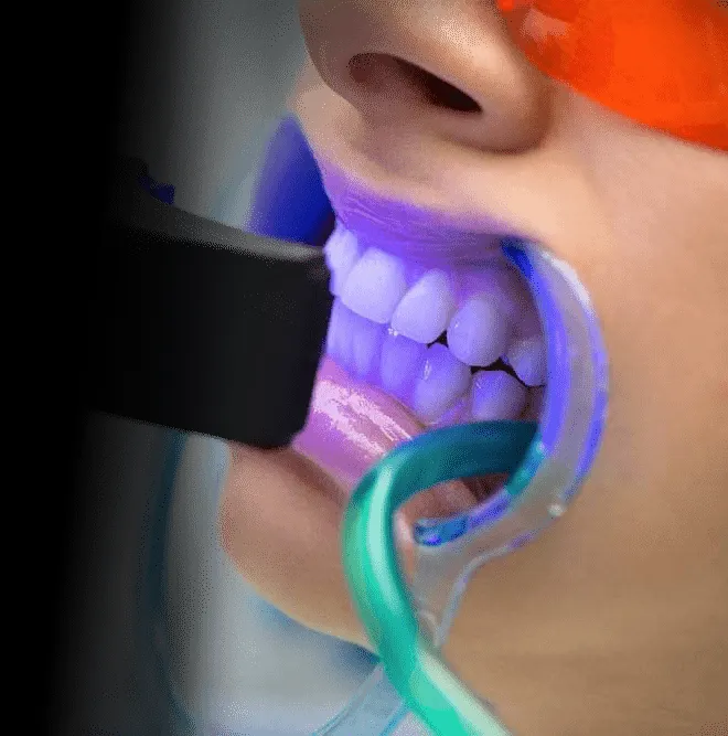 25390 at home whitening kit