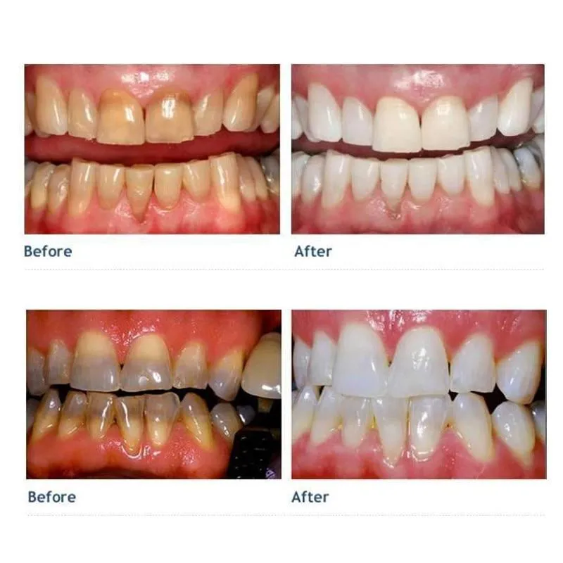 25394 pro nano kit before after