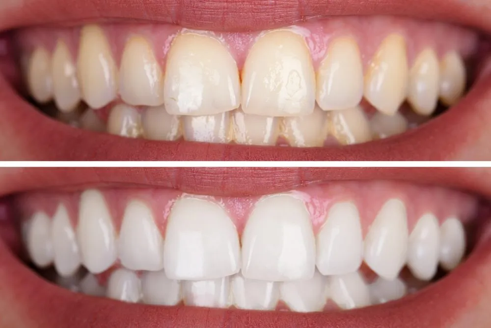25395 dental veneers