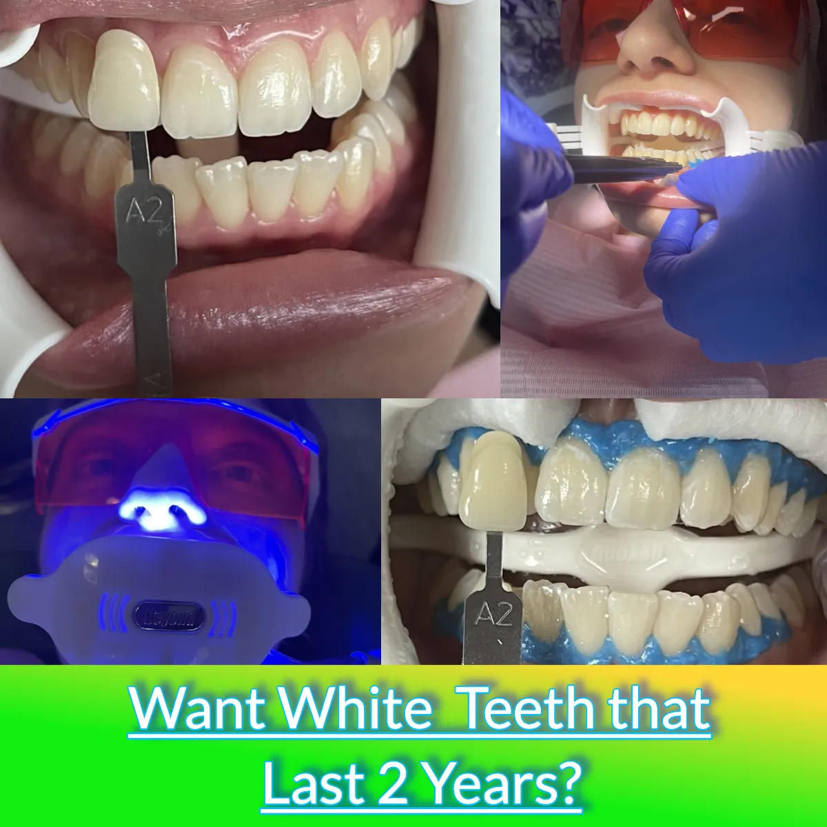 25395 teeth whitening alternatives
