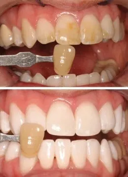 25396 jackson teeth whitening dentist