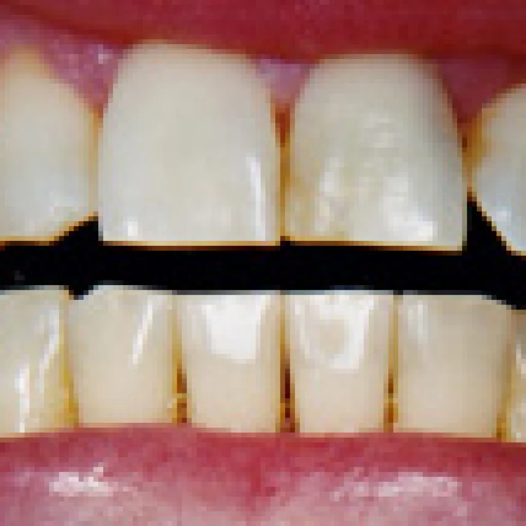 25403 sensitive teeth whitening