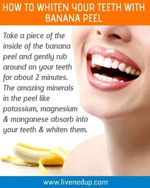 25406 at home teeth whitening kit