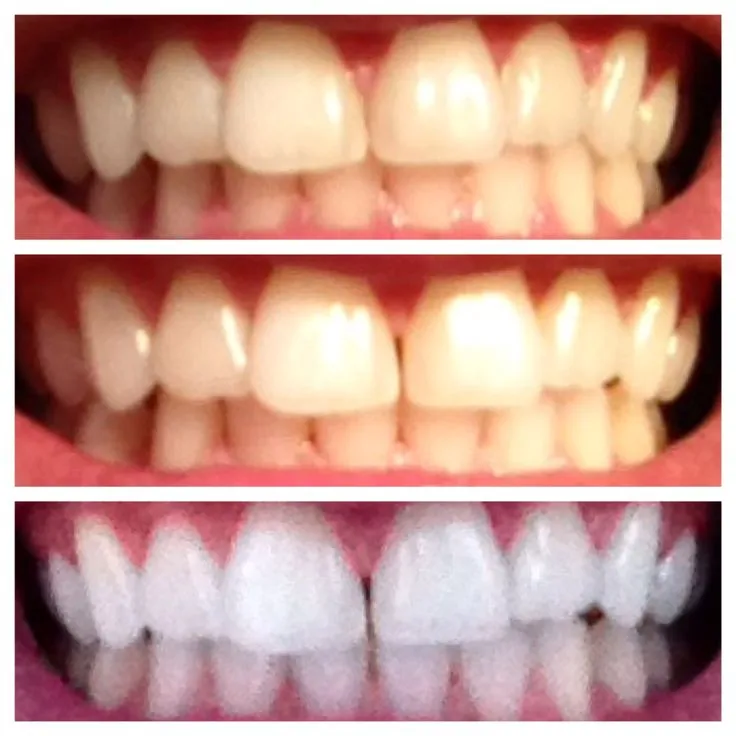 25406 dental bonding