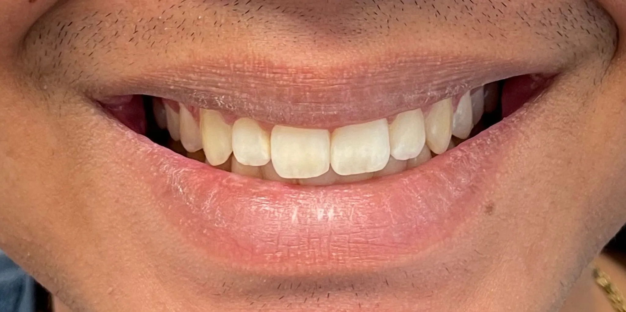 25411 before after muddy mouth