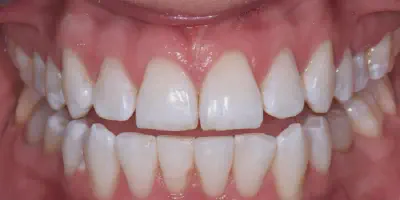 /img/25413-teeth-whitening-cost-norfolk.webp
