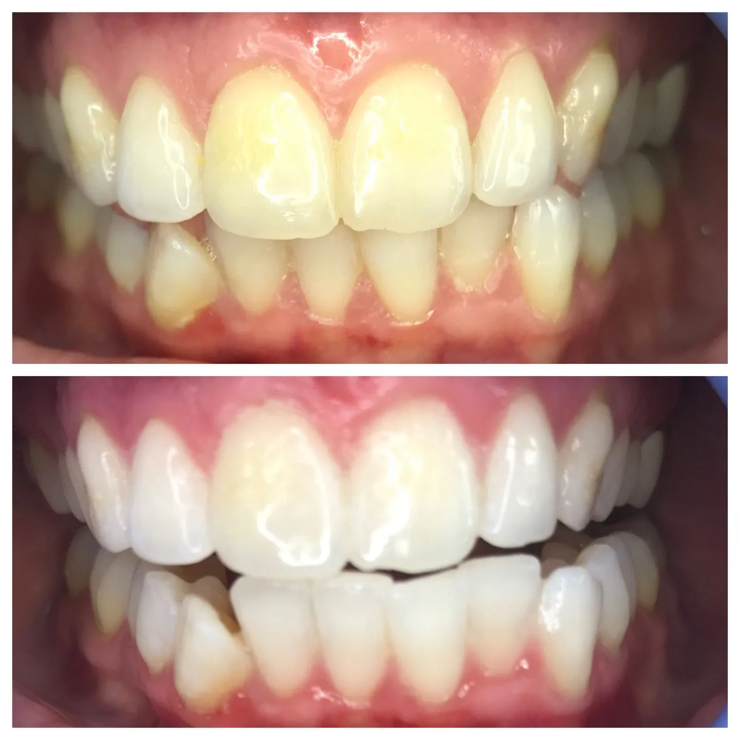 25414 radiance teeth whitening before after