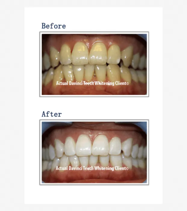 25420 brushing teeth correctly