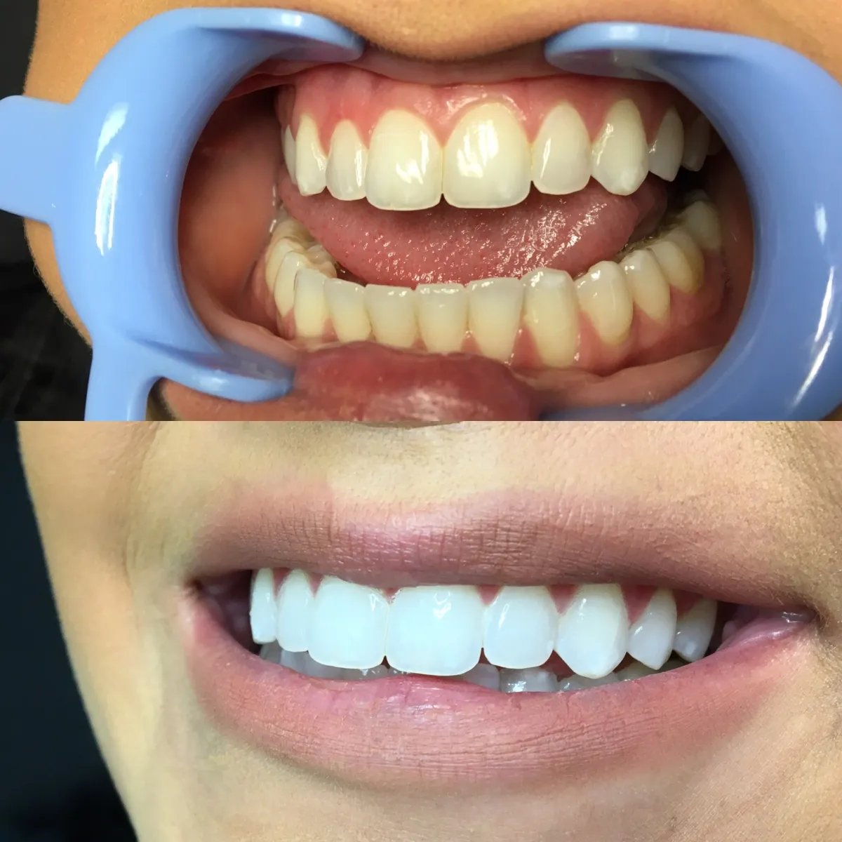 25420 professional teeth cleaning