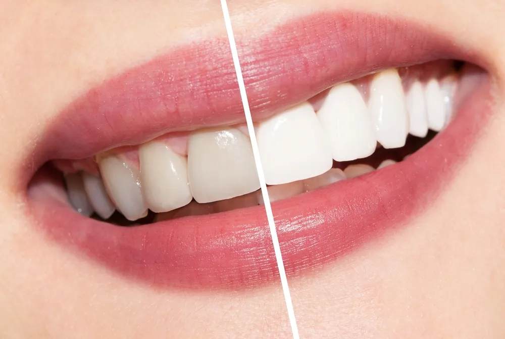 25427 smile secret teeth whitening comparison