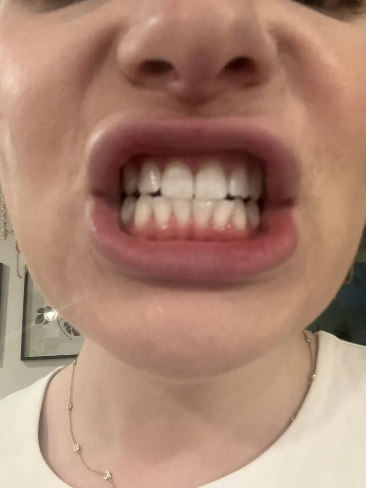 25427 smile secret teeth whitening results