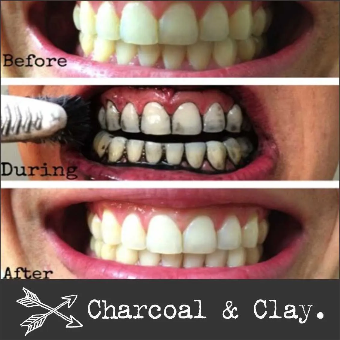 25432 healthy smile after whitening